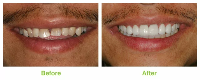 Salt Lake City porcelain veneer patient before and after.