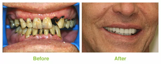 Patient who had a dramatic smile makeover in Murray UT.