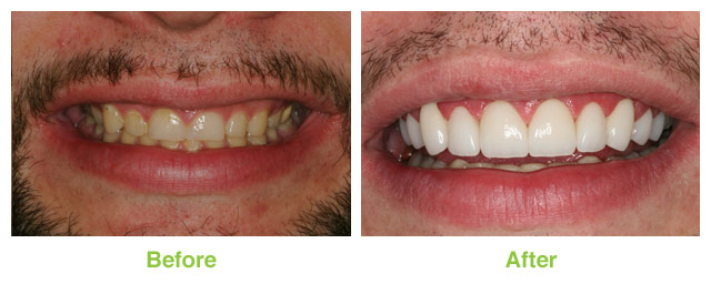 Before and after photo of a porcelain veneer and laser dentistry patient from Sandy UT.