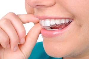 Invisalign invisible braces with a Murray dentist Sandy Utah