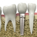 Image of a tooth implant, available as part of implant dentistry services near Salt Lake City and Sandy Utah