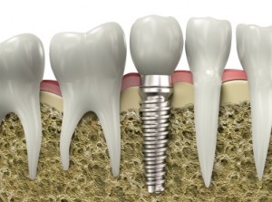 dental implants Salt Lake City