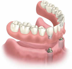 Implant supported dentures in Murray, UT can restore smile aesthetics and bite function.