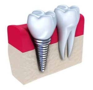 A graphic image of a dental impant in the jawbone.