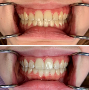A before and after of in office whitening treatments in Salt Lake City.