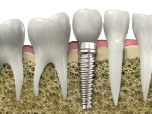 A graphic image of a dental implant embedded in a jawbone.